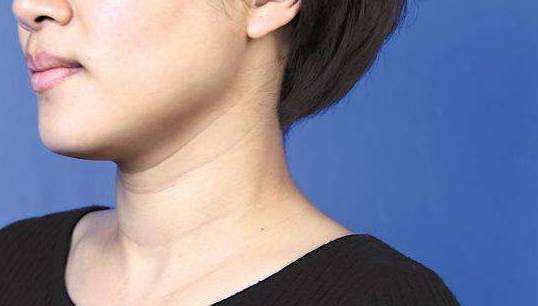 上海自体脂肪填充多大年龄做好,填充后可以保持多久