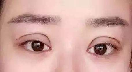 美莱激光祛雀斑和祛痣的效果好不好?