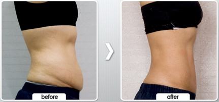 美莱激光祛雀斑和祛痣的效果好不好?