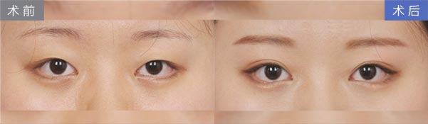 上海美莱隆鼻:隆鼻能让我们颜值提升多少呢