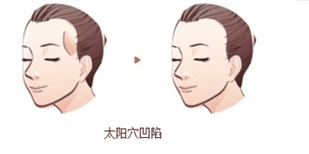 【美莱隆鼻科普】假体隆鼻后到底能不能挤黑头?