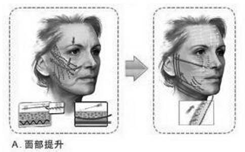 上海做假体隆下巴和注射玻尿酸丰下巴的区别是哪些