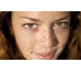 脸上有斑怎么办,如何去除黄褐斑好呢?