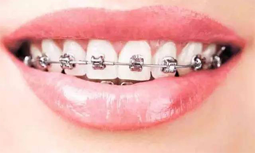 上海鼻翼缩小手术多少钱