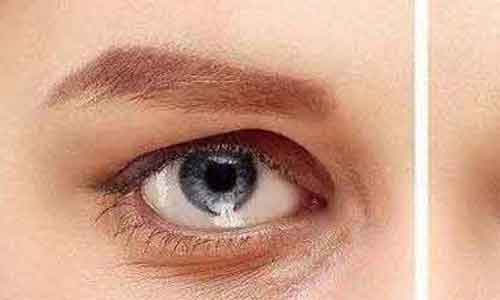 上海鹰钩鼻矫正手术方法是什么?