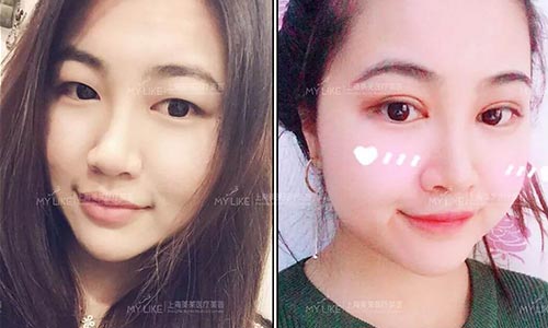 上海激光嫩肤好不好-同时可以缩小毛孔吗