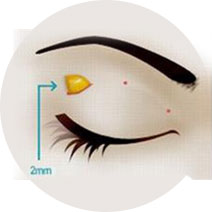 美莱激光脱毛效果怎么样:优点都有哪些