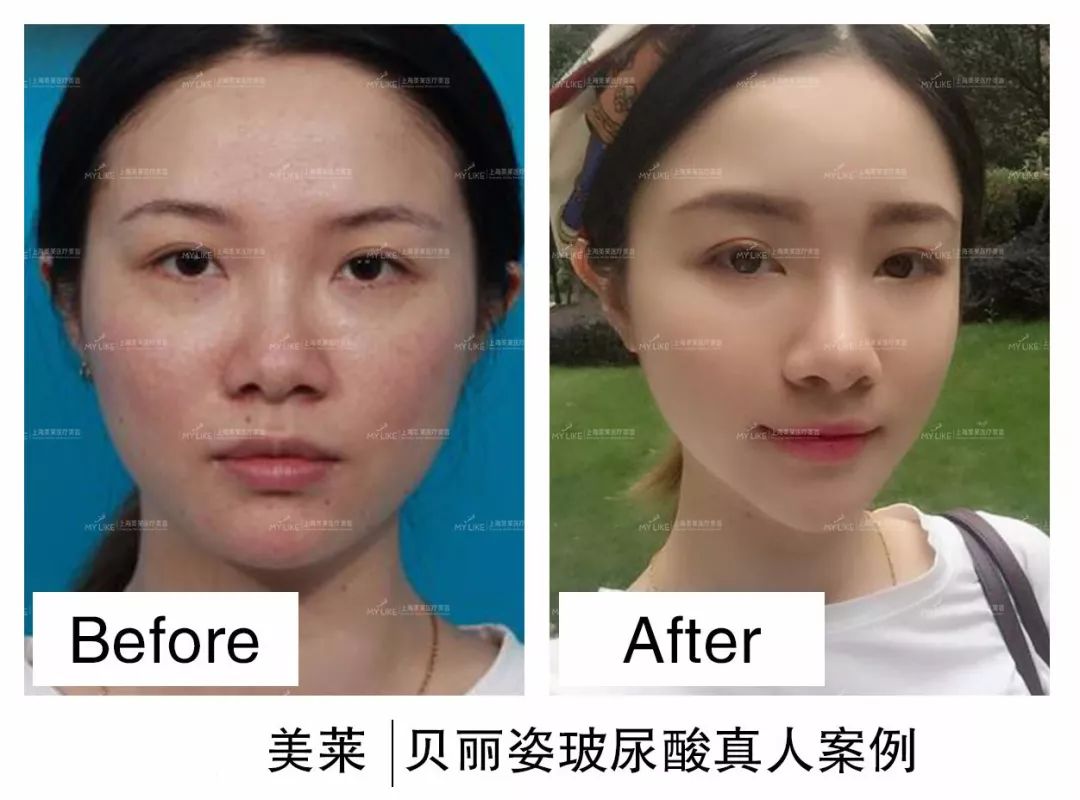 上海比基尼部位脱毛方法,什么方法好?