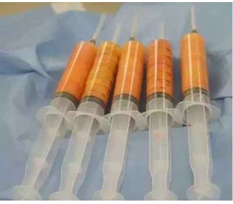 上海腹部吸脂减肥对身体有伤害吗