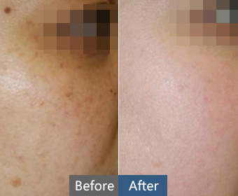 埋线双眼皮修复注意事项有哪些!