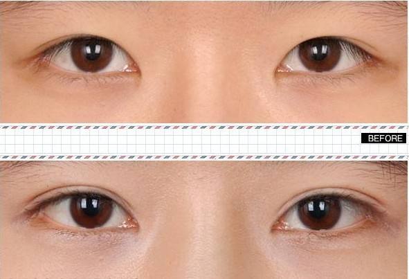 激光祛斑需要几次,会不会反弹呢?