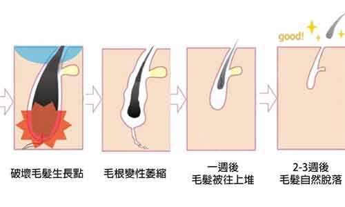 上海注射隆鼻能保持多久,能保持一年时间吗?
