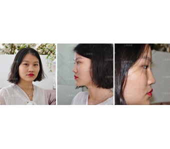 美莱医生告诉你:埋线双眼皮脱线怎么办