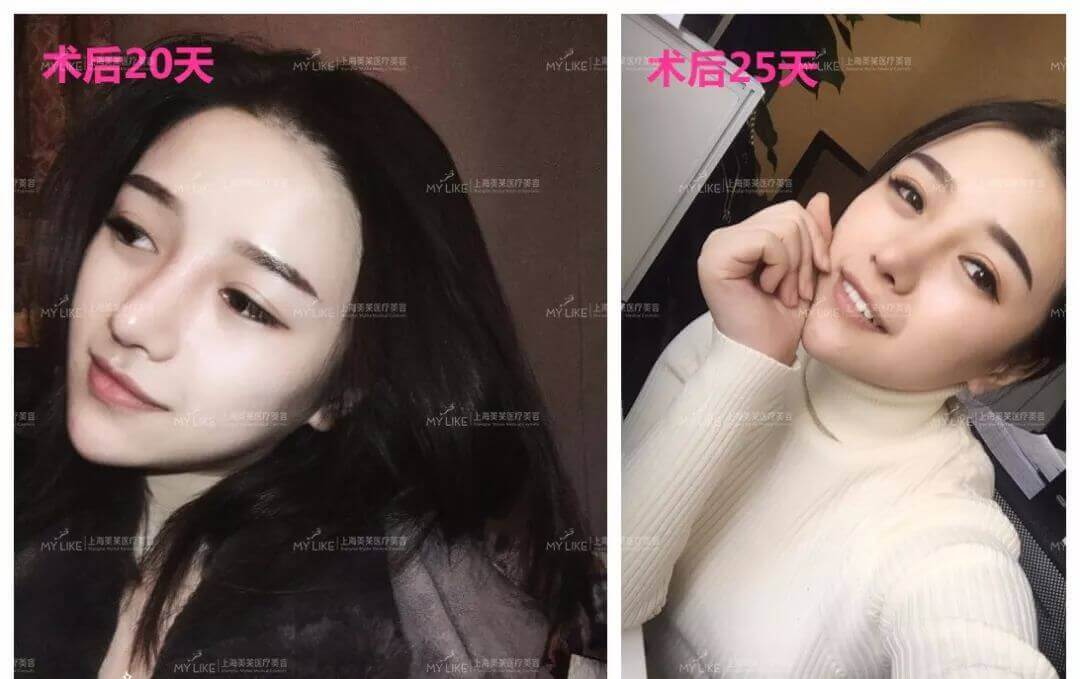 <a href='/' target='_blank'><u>上海美莱</u></a>注射瘦脸针案例