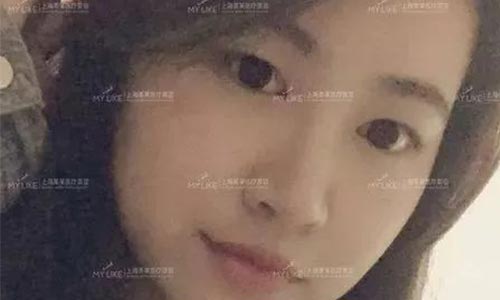上海美莱玻尿酸填充案例+肖玮