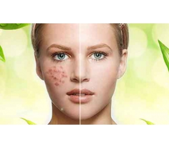 上海美莱玻尿酸填充案例+肖玮