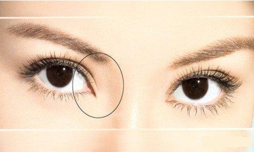 美莱眼部整形双眼皮案例+何祥龙