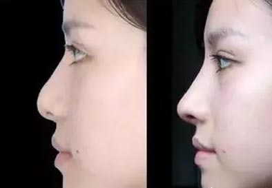 在上海做埋线双眼皮失败了怎么办?