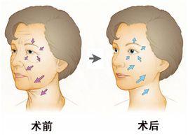 一般上海除皱多少钱一次,贵吗