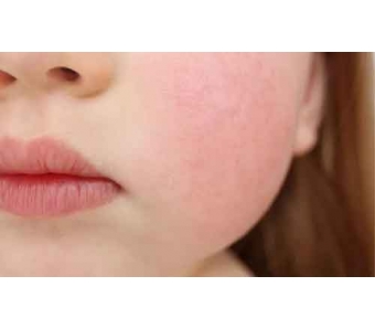 美莱做开眼角什么时候能恢复