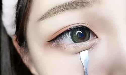 美莱做开眼角什么时候能恢复