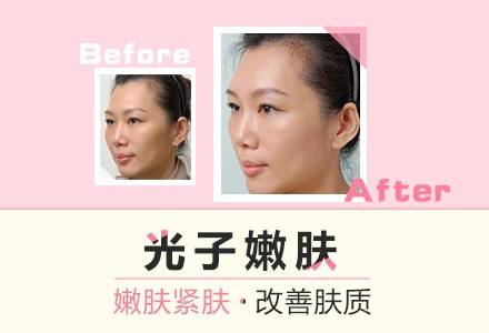 上海美莱医疗打了瘦脸针见效快吗
