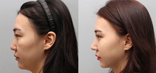 上海美莱皮肤科普光子嫩肤事项及效果