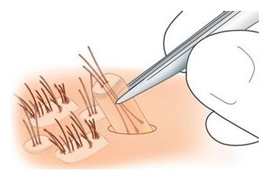 上海的整形医院做激光祛斑后多久恢复呢