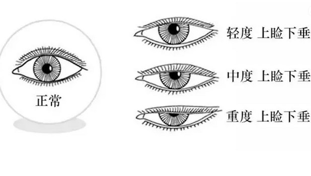 上海一般做缩小鼻翼手术多少钱