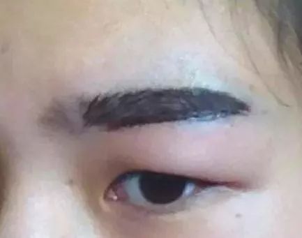 去除黑眼圈什么方法好 ?美莱如何去除黑眼圈?