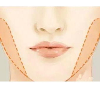 在美莱做了自体脂肪丰胸会对哺乳造成影响吗