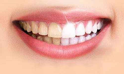 上海吸脂医院,腹部去除赘肉好的方法