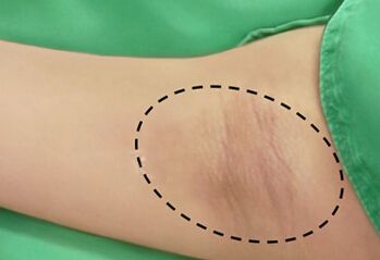 上海美莱做鼻尖手术价格怎么样，好不好