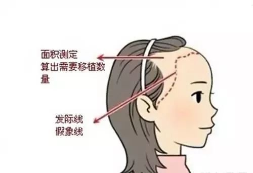 【上海美莱科普】上睑下垂如何来改善？