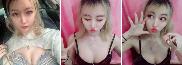 上海做注射隆鼻要大概多少费用啊