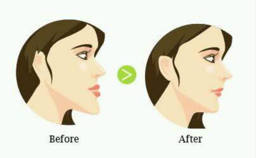 整形埋线双眼皮的效果管多久在上海美莱？