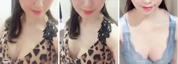 注射玻尿酸隆鼻玻尿酸越多越好吗，美莱怎么看！