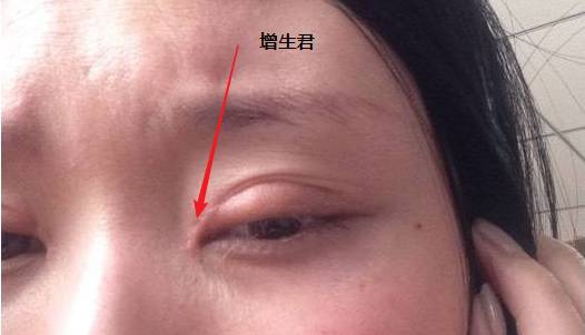 上海割双眼皮到底有多痛∷会打麻醉吗?