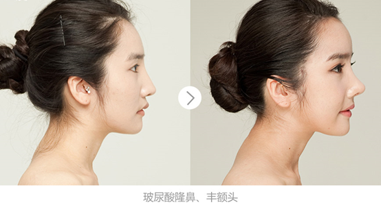 上海鼻翼缩小手术后多久可以上班∥怎么护理恢复快?
