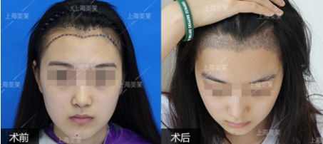 【上海美莱官网】自体脂肪丰胸真的可以让胸变大吗