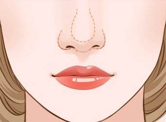 隆鼻尖手术千万要注意，<a href='/' target='_blank'><u>上海美莱</u></a>医疗给您护理！