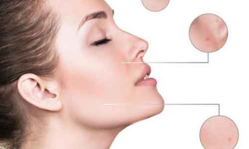 微创重睑双眼皮术，美莱细细跟你唠！