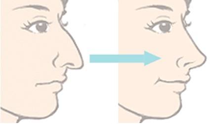 <美莱>打完瘦脸针后的注意事项都有哪些?