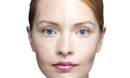 在美莱做韩式隆鼻恢复时是多久,多少天消肿恢复自然?