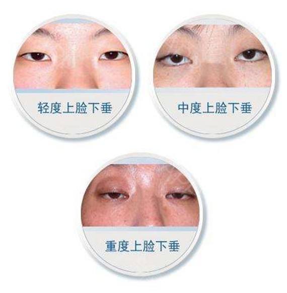 上海做注射祛皱美莱玻尿酸除皱大约的价格是多少