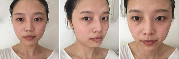 美莱开眼角医院好不好,有什么优势?