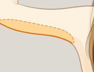 上海丰胸，假体隆胸价格表是怎么样的