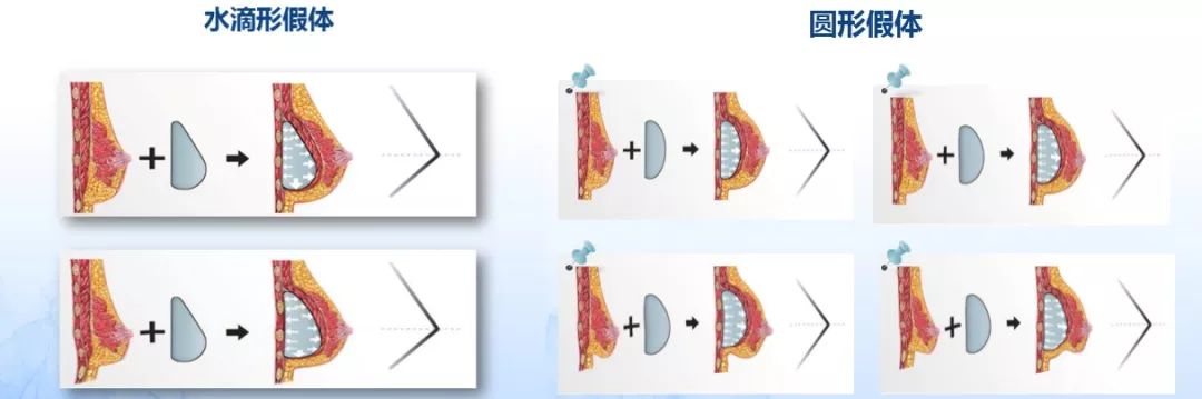 <a href='/' target='_blank'><u>上海美莱</u></a>杜医生科普:双眼皮手术失败了该怎样修复?