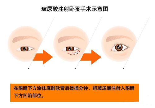 上海美莱美容院做了假体丰胸究竟多久能恢复?