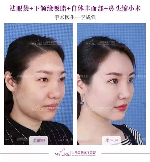 美莱做手臂吸脂手术前需要的注意是哪些